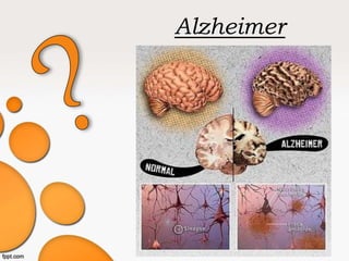 Alzheimer
 