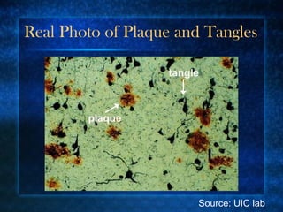 Real Photo of Plaque and Tangles Source: UIC lab 