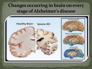Changes occurring in brain on every
stage of Alzheimer’s disease

 