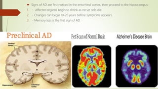  Signs of AD are first noticed in the entorhinal cortex, then proceed to the hippocampus:
1. Affected regions begin to shrink as nerve cells die.
2. Changes can begin 10-20 years before symptoms appears.
3. Memory loss is the first sign of AD.
 