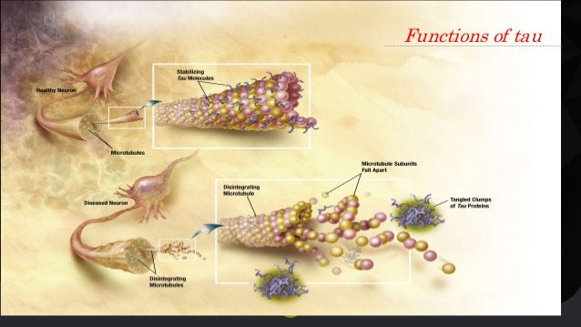Beta Amyloid Plaques >> Biochemistry of Alzheimers disease Beta Amyloid Plaques >> Biochemistry of Alzheimers disease