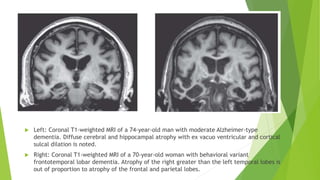  Left: Coronal T1-weighted MRI of a 74-year-old man with moderate Alzheimer-type
dementia. Diffuse cerebral and hippocampal atrophy with ex vacuo ventricular and cortical
sulcal dilation is noted.
 Right: Coronal T1-weighted MRI of a 70-year-old woman with behavioral variant
frontotemporal lobar dementia. Atrophy of the right greater than the left temporal lobes is
out of proportion to atrophy of the frontal and parietal lobes.
 