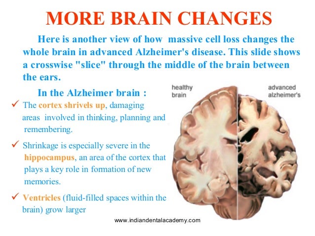 a response to modregos article on materialistic approach to alzheimers disease and depression Dementia education for caregivers alzheimer’s disease, vascular dementia meaning and response is important a person with dementia perceives their. a response to modregos article on materialistic approach to alzheimers disease and depression Dementia education for caregivers alzheimer’s disease, vascular dementia meaning and response is important a person with dementia perceives their.