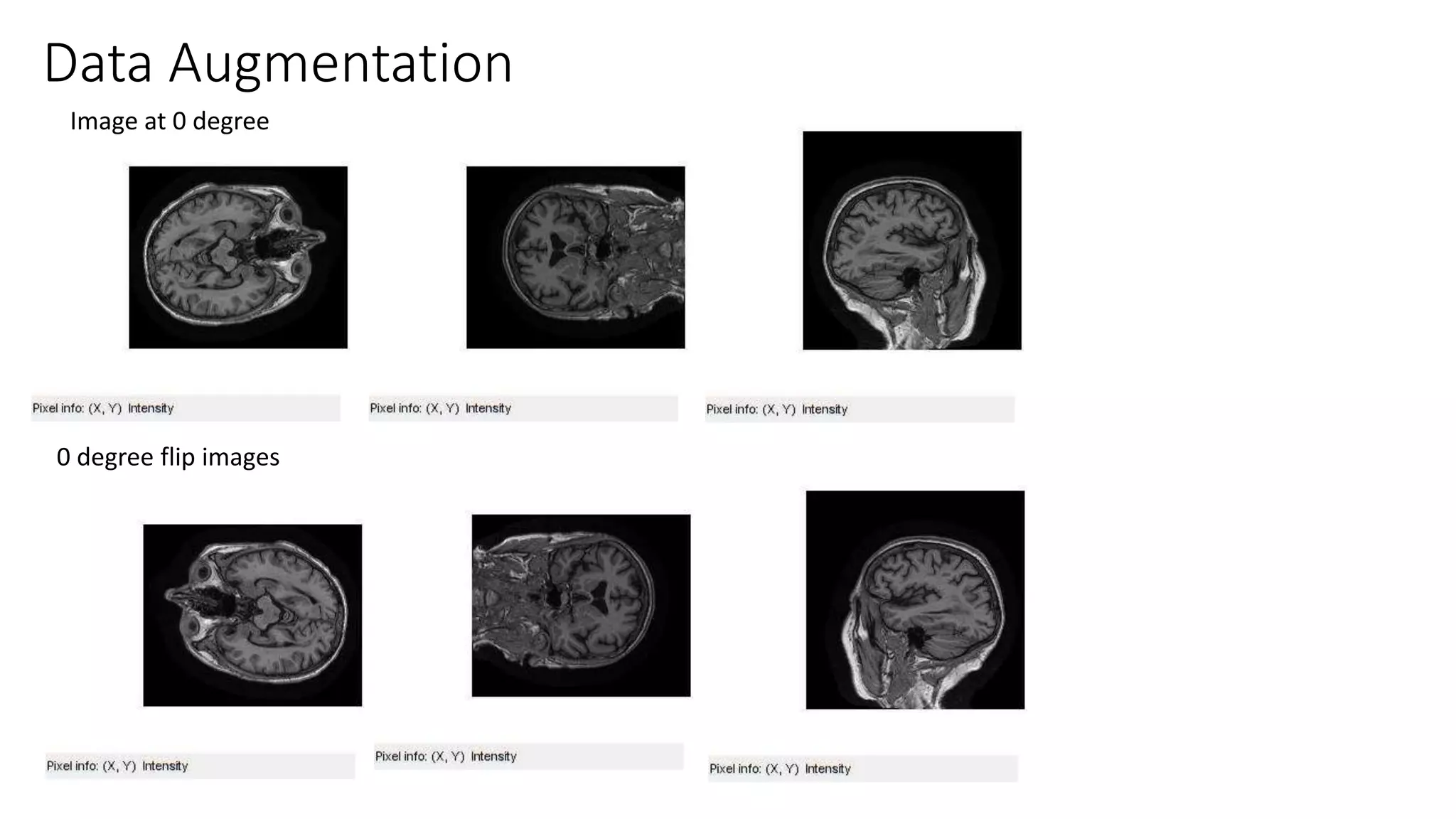 Alzheimer's disease classification using Deep learning Neural a Network ...