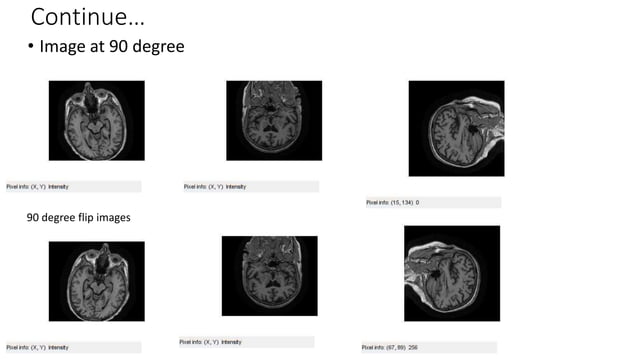 Alzheimer's disease classification using Deep learning Neural a Network ...