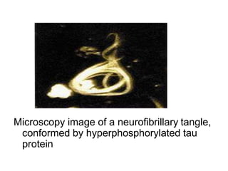 Microscopy image of a neurofibrillary tangle,
conformed by hyperphosphorylated tau
protein
 