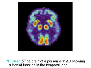 PET scan of the brain of a person with AD showing
a loss of function in the temporal lobe
 