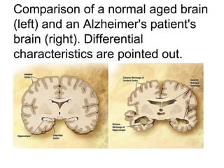 Comparison of a normal aged brain
(left) and an Alzheimer's patient's
brain (right). Differential
characteristics are pointed out.
 