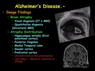 Alzheimer’s Disease.-
• Image Findings
– Brain Atrophy
• Visual diagnosis (CT o MRI)
• Quantitation diagnosis
(Structural MRI)
– Atrophy Distribution:
• Hippocampus initially (first
entorhinal cortex)
• Posterior Cingulum
• Medial Temporal Lobe
• Insular cortex
• Prefrontal cortex
• Orbitofrontal cortex preservation
• Late stage----Bilateral, simmetric &
diffuse.
 