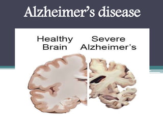 Alzheimer's disease : Overview, Symptoms, Risk Factor, Causes ...