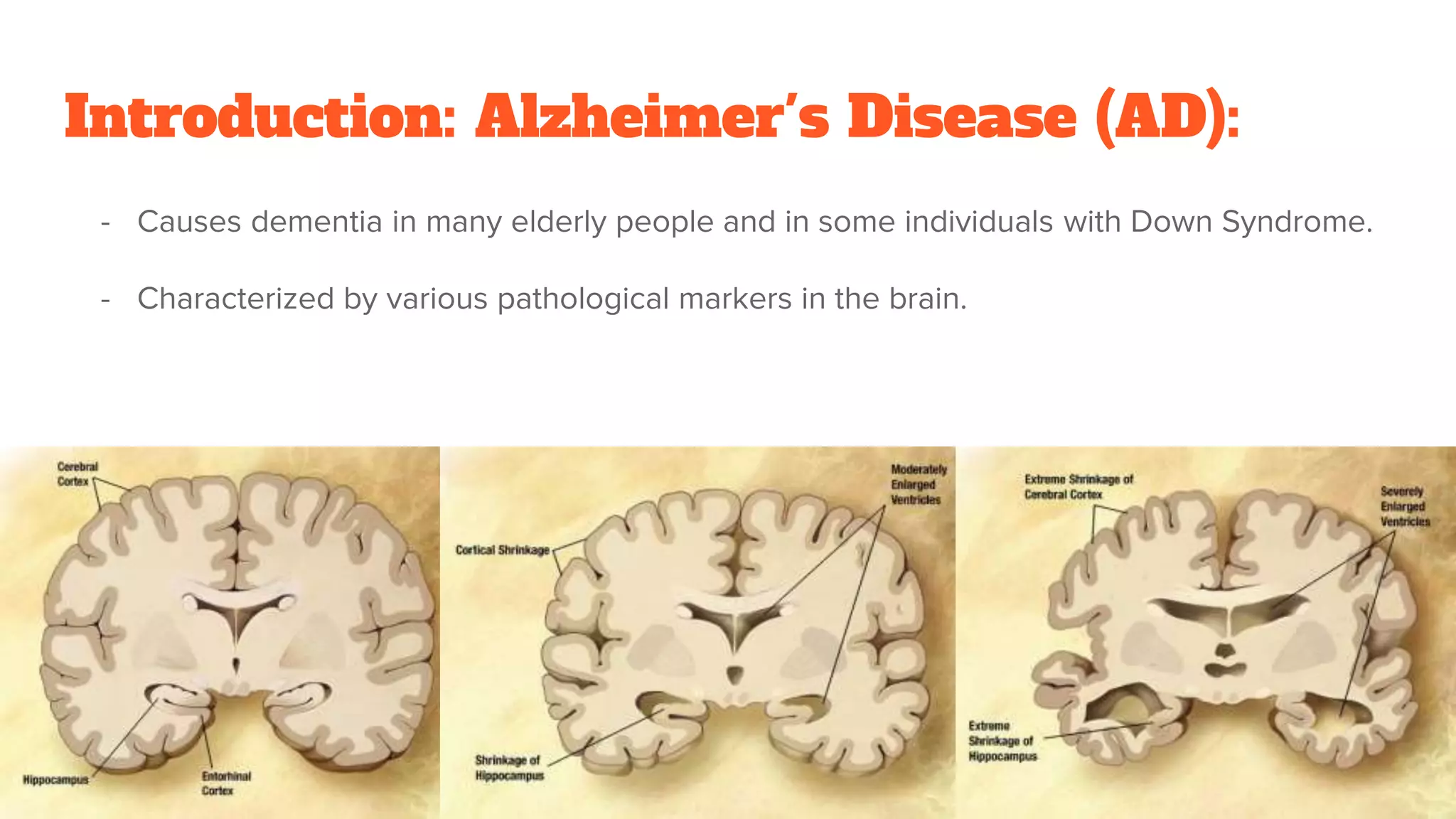 Alzheimer’s disease the amyloid cascade hypothesis presentation | PPTX