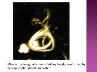 Microscopy image of a neurofibrillary tangle, conformed by
hyperphosphorylated tau protein.
 