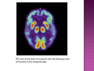 .




    PET scan of the brain of a person with AD showing a loss
    of function in the temporal lobe.
 