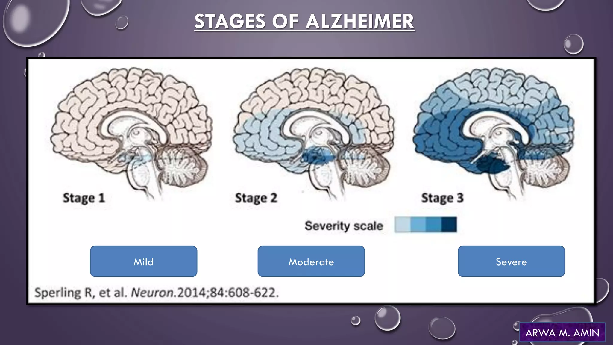 Alzheimer's Disease (AD) | PDF