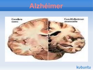 Alzhéimer
 