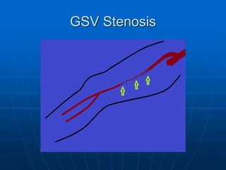 The Great Saphenous Vein | PDF