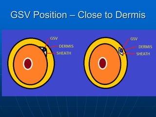 The Great Saphenous Vein | PDF