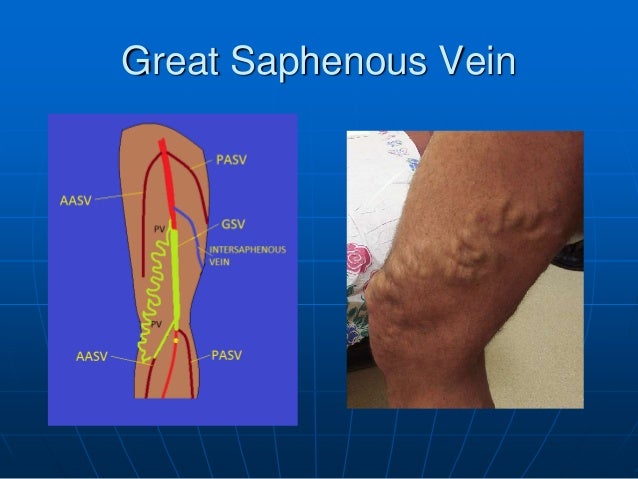 The Great Saphenous Vein