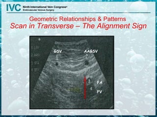 Scan in Transverse – The Alignment Sign
AAGSVGSV
FA
FV
Geometric Relationships & Patterns
 