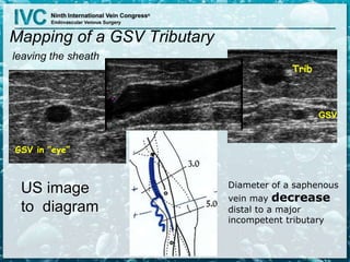 Mapping of a GSV Tributary
leaving the sheath
GSV
Trib
GSV in “eye”
US image
to diagram
Diameter of a saphenous
vein may decrease
distal to a major
incompetent tributary
 