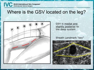 GSV is medial and
slightly posterior to
the deep system
Sheath Landmark “key”
Where is the GSV located on the leg?
 