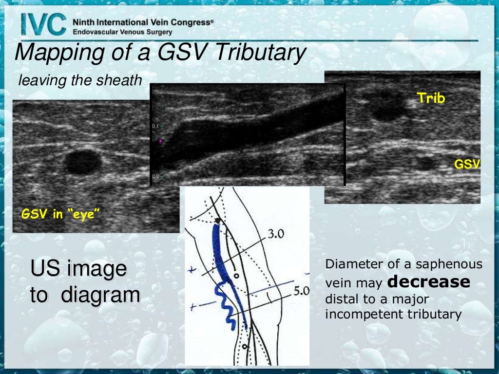venous reflux ultrasound