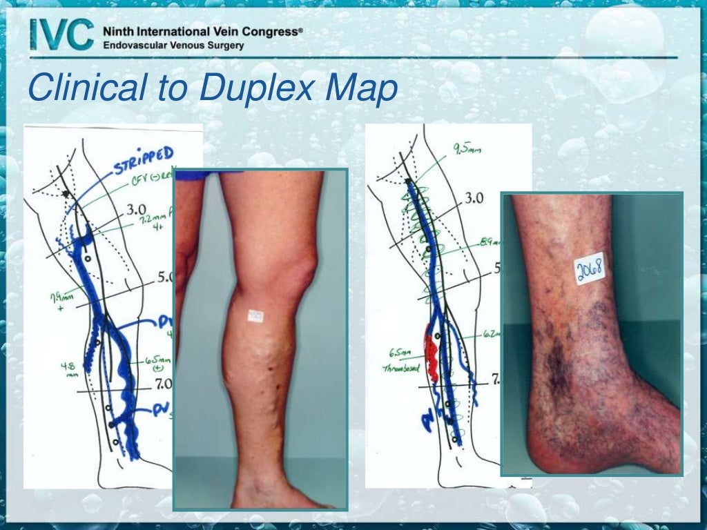 Duplex for Superficial Venous Disease