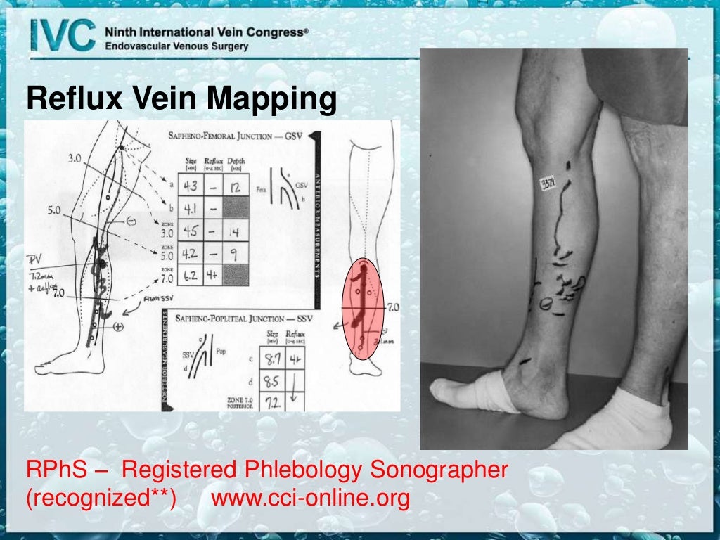 Duplex for Superficial Venous Disease