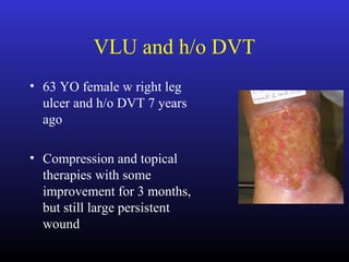 VLU and h/o DVT
• 63 YO female w right leg
ulcer and h/o DVT 7 years
ago
• Compression and topical
therapies with some
improvement for 3 months,
but still large persistent
wound
 