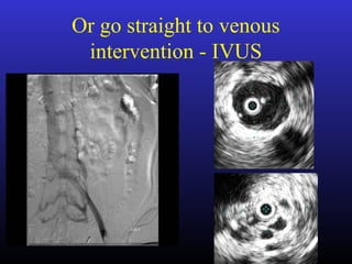 Or go straight to venous
intervention - IVUS
 