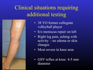 Clinical situations requiring
additional testing
• 38 YO former collegiate
volleyball player
• h/o meniscus repair on left
• Right leg pain, aching with
activity - no edema or skin
changes
• Most severe in knee area
• GSV reflux at knee 4-5 mm
diameter
 
