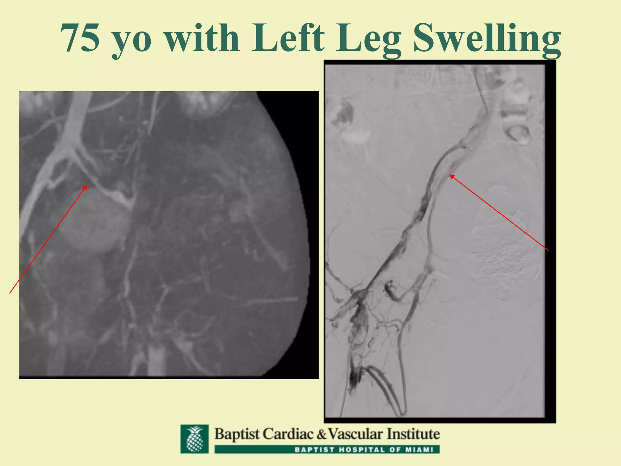 75 yo with Left Leg Swelling
 