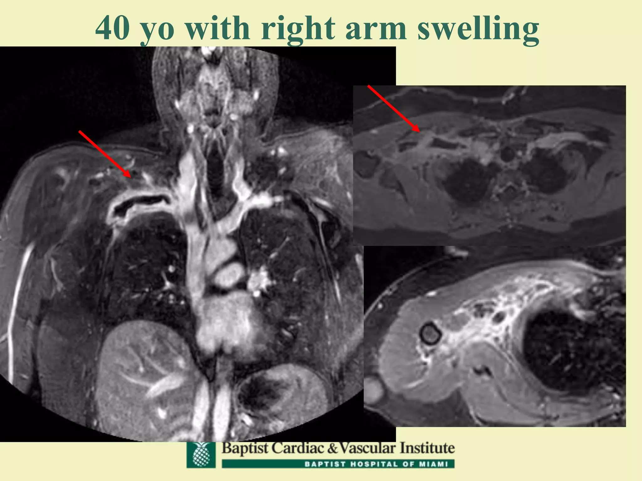 40 yo with right arm swelling
 