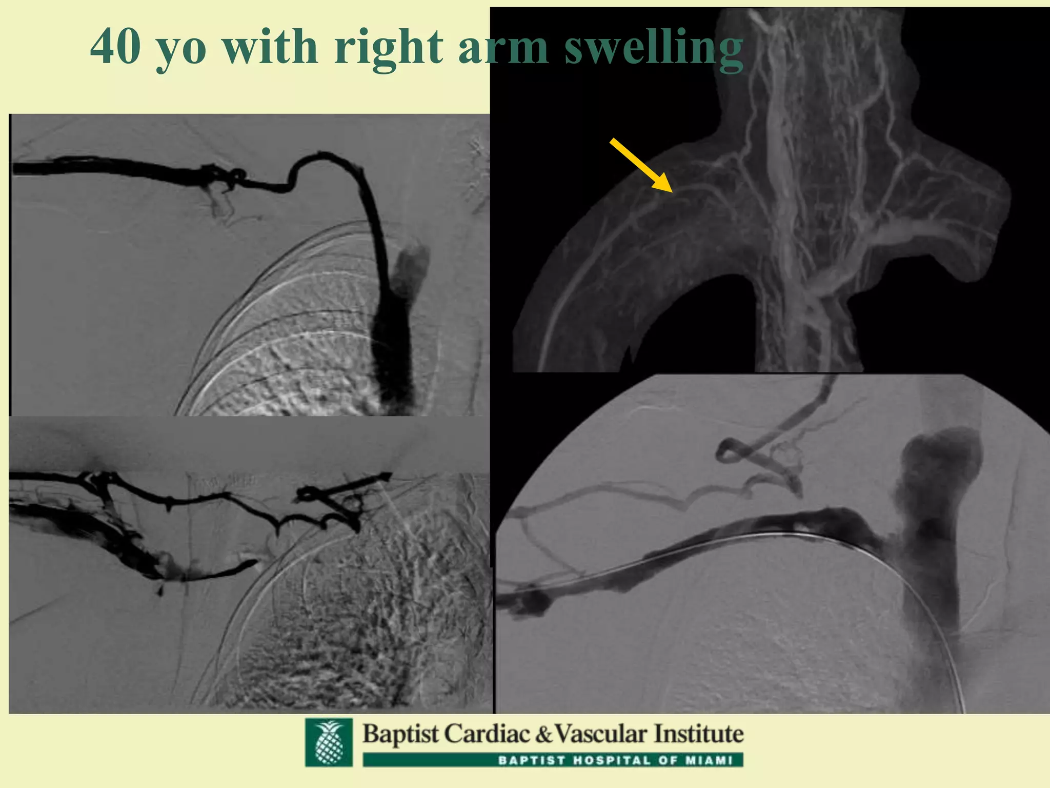 40 yo with right arm swelling
 