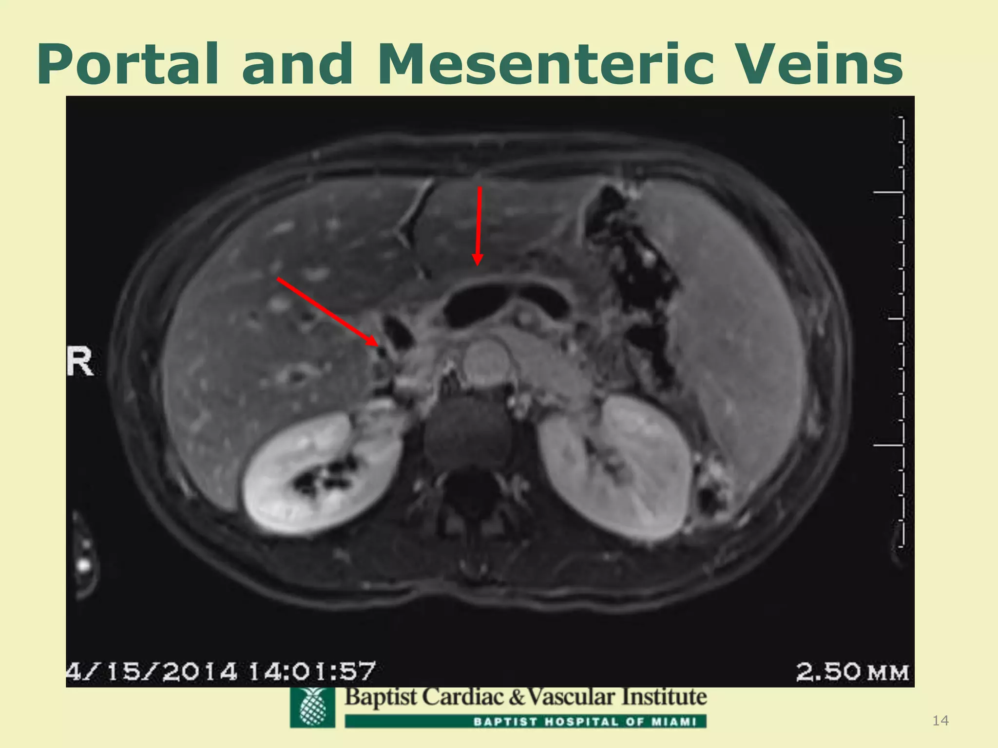14
Portal and Mesenteric Veins
 
