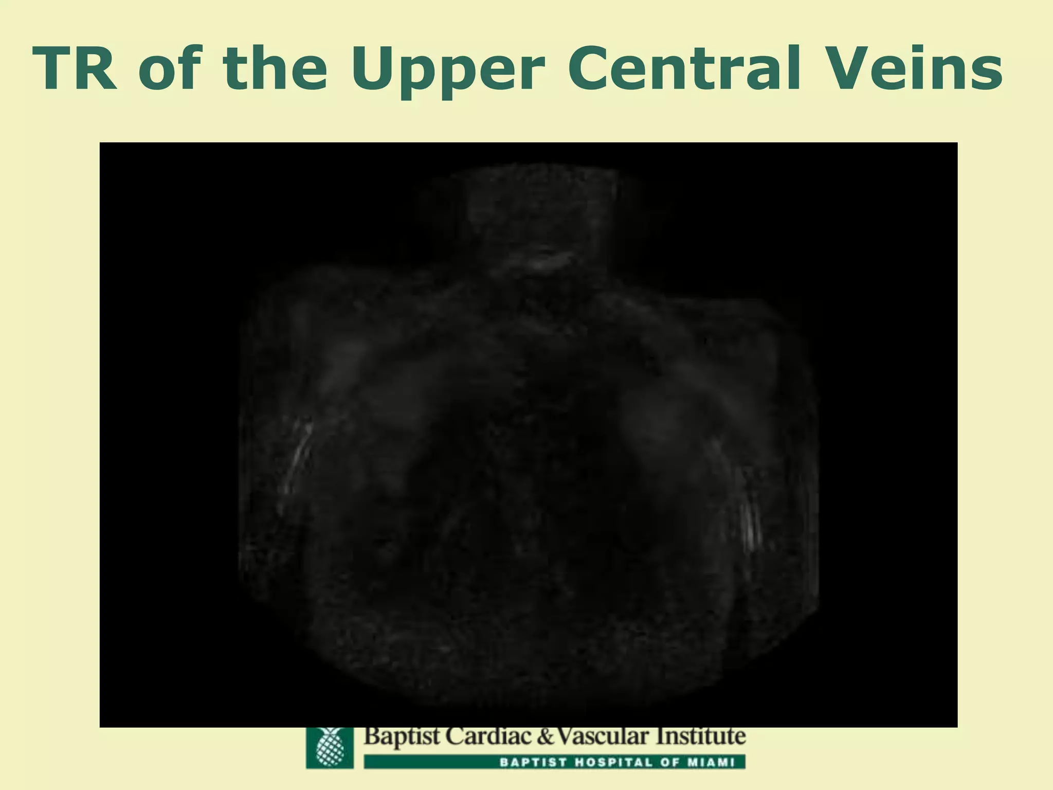 TR of the Upper Central Veins
 