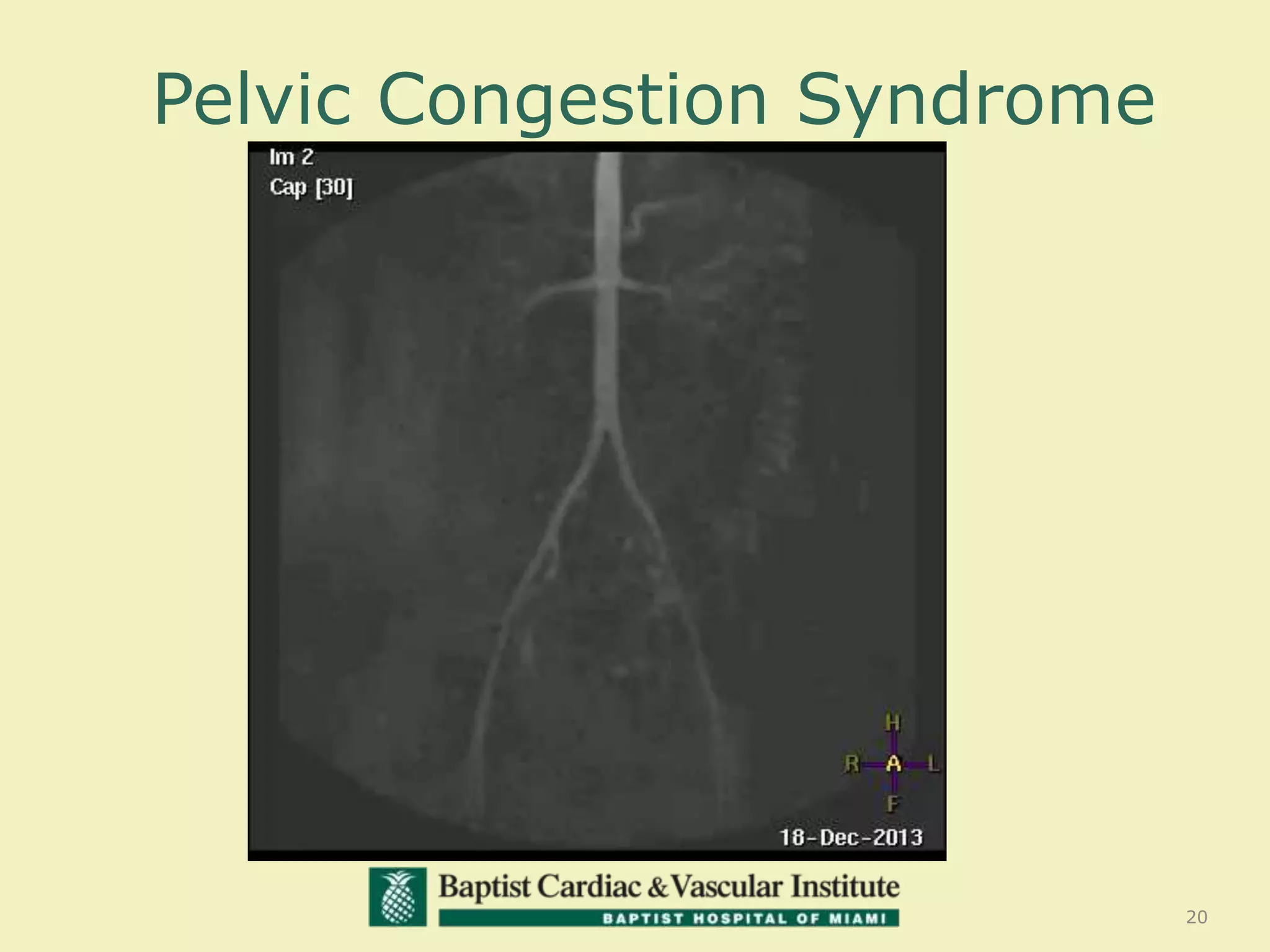 Pelvic Congestion Syndrome
20
 
