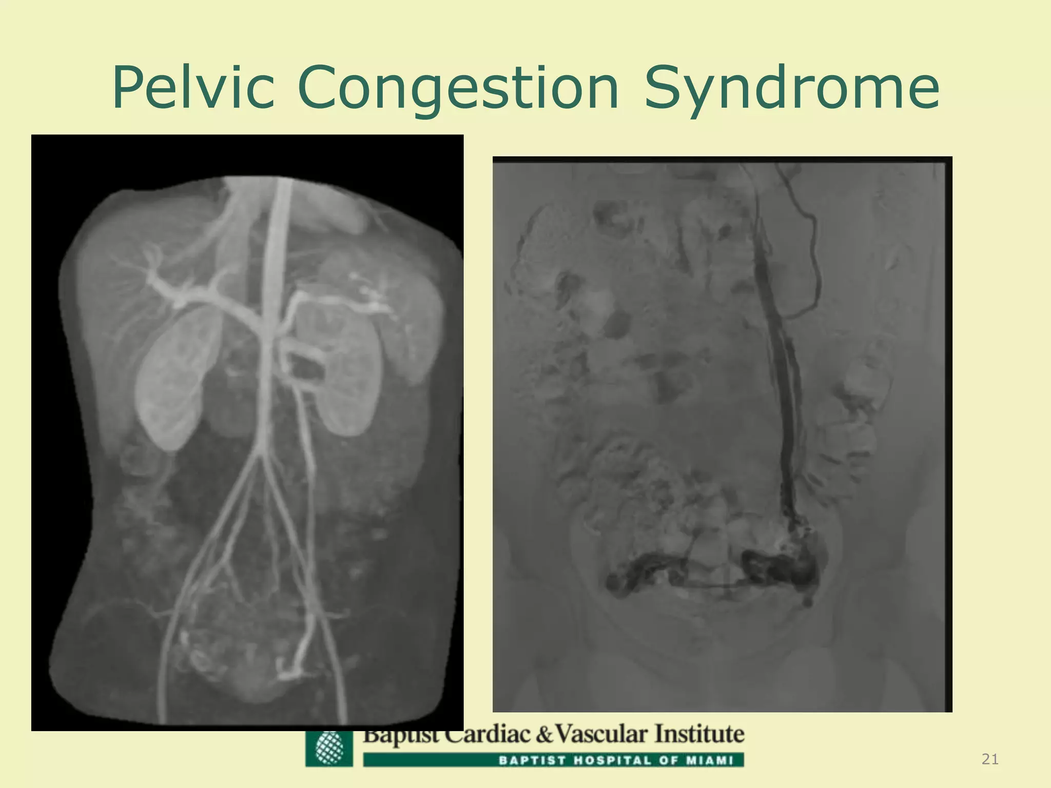 Pelvic Congestion Syndrome
21
 