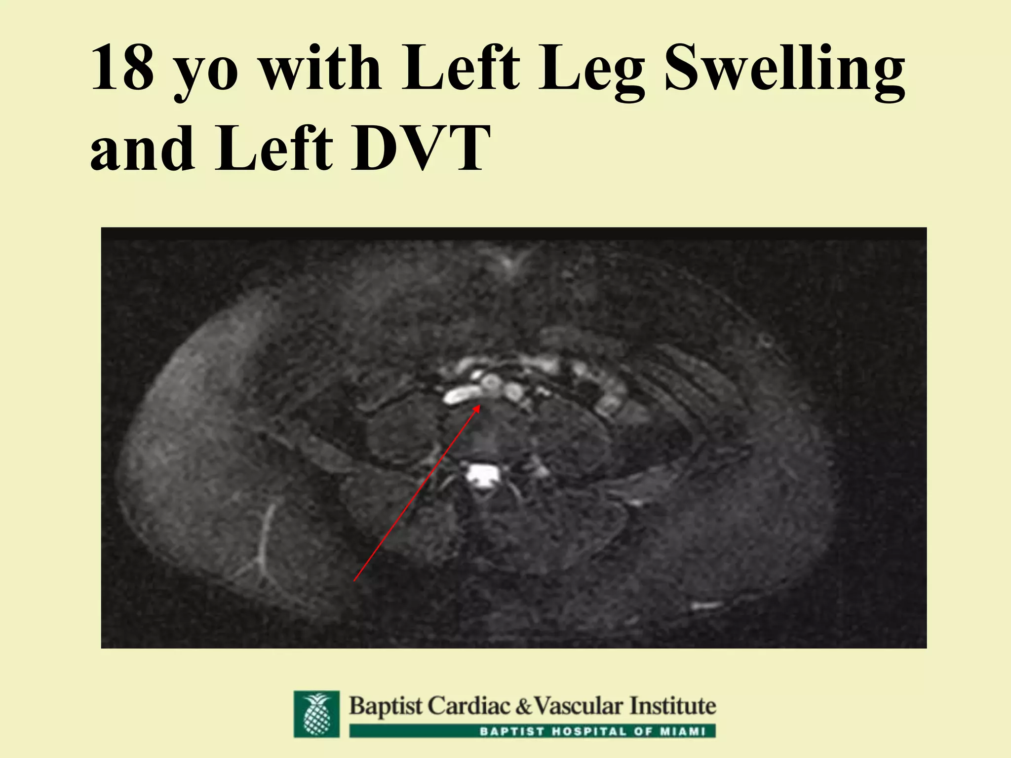 18 yo with Left Leg Swelling
and Left DVT
 