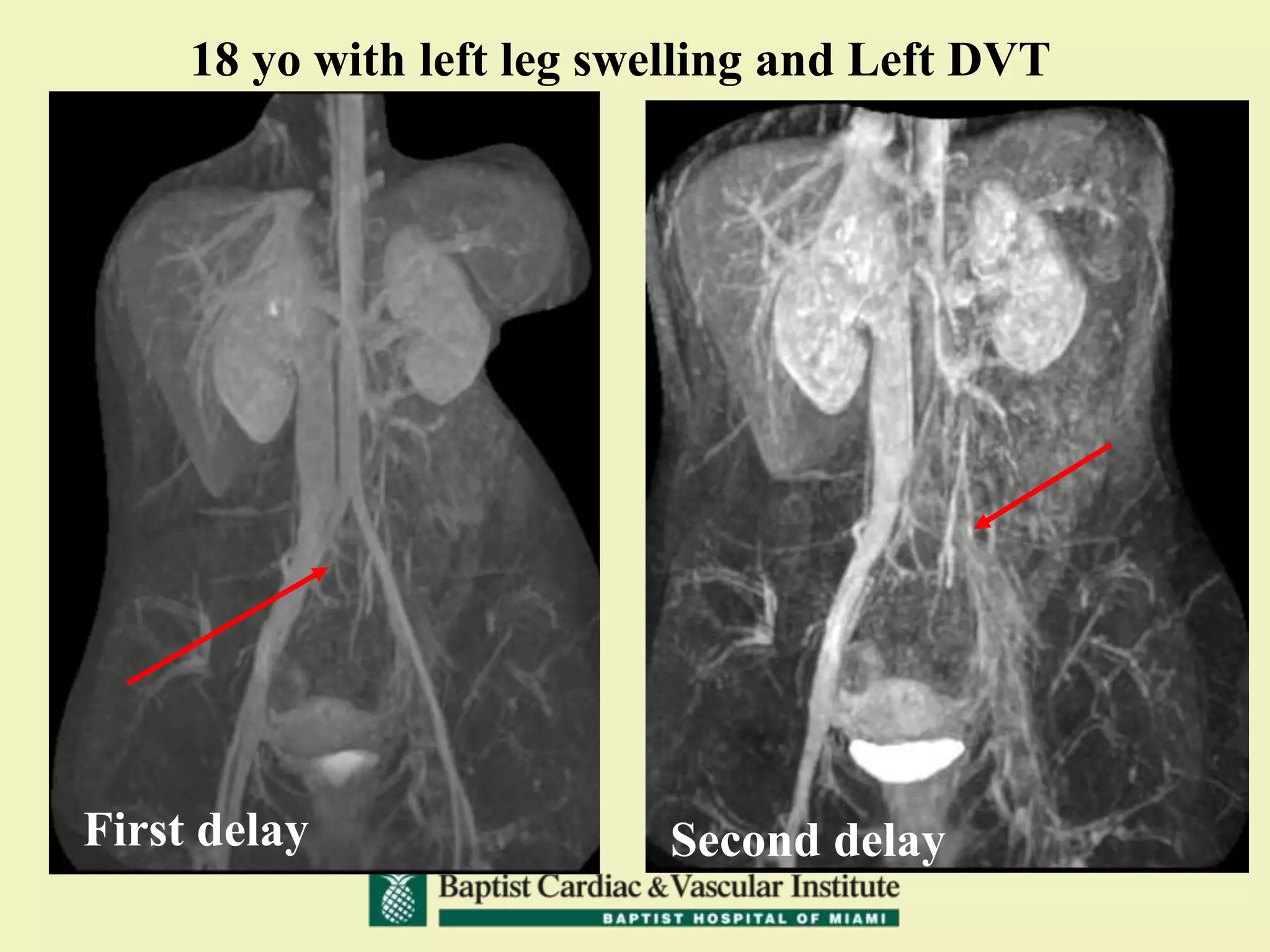 18 yo with left leg swelling and Left DVT
First delay Second delay
 