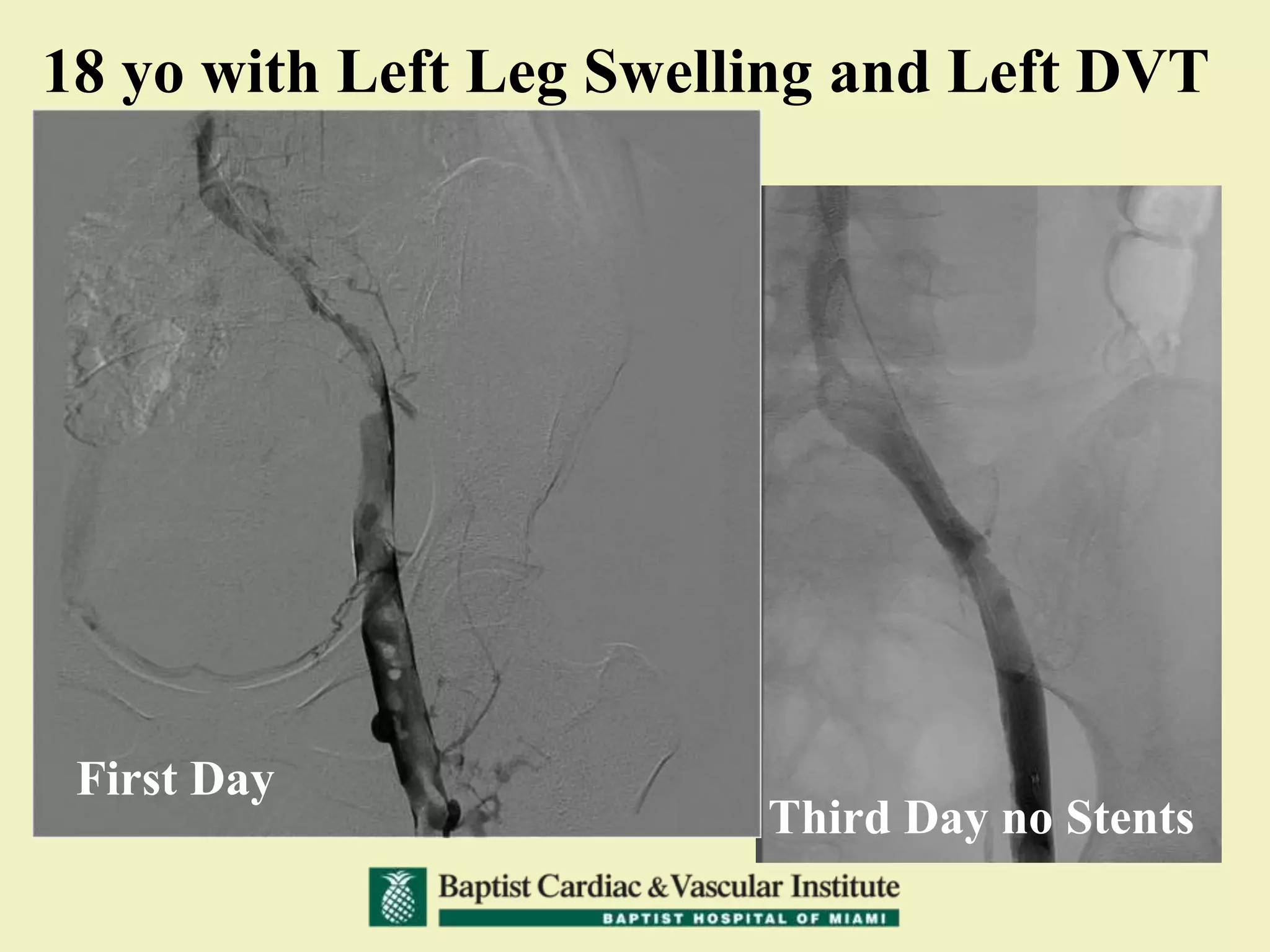18 yo with Left Leg Swelling and Left DVT
First Day
Third Day no Stents
 