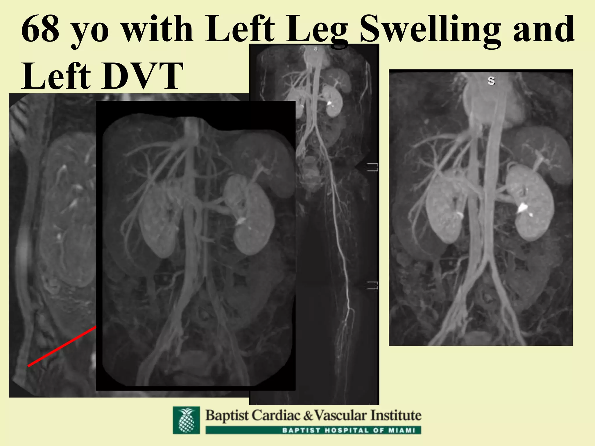 68 yo with Left Leg Swelling and
Left DVT
 