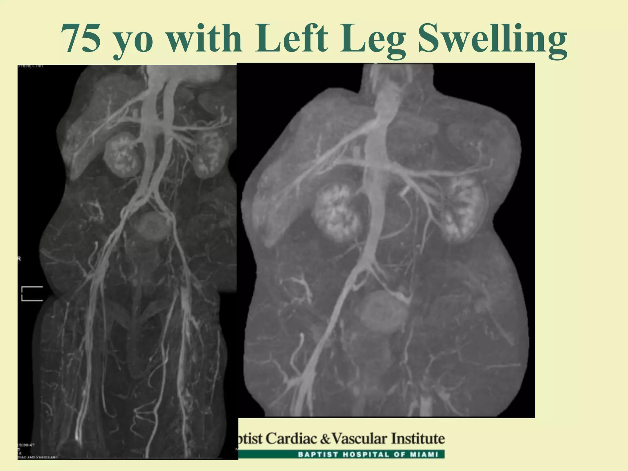 75 yo with Left Leg Swelling
 