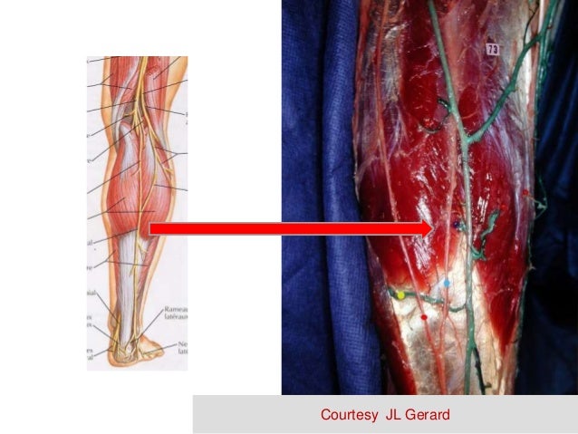 Small Saphenous Thermal Ablation