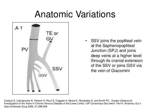 Small Saphenous Thermal Ablation