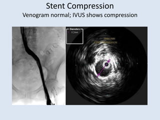 Compression Band Racket Ivu Pitfalls of IVUS Imaging | PPTX