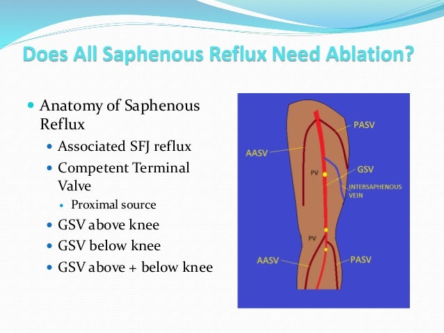 does-all-saphenous-reflux-need-ablation