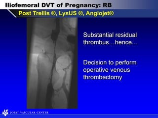 Deep Vein Pathophysiology: Reflux & Obstruction | PDF