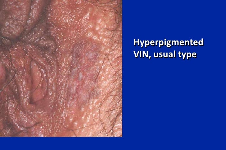 Am 8.45 policar vulvovag