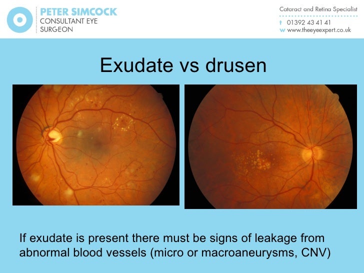 macular pathology and oct update for optometrists